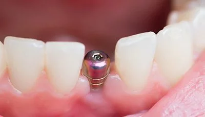 دوره جامع آموزش ایمپلنت های دندانی مقدماتی